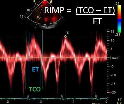 RIMP to assess RV Function – What is RIMP?