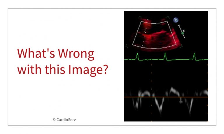 Avoid These Diastology Measurement Errors Cardioserv