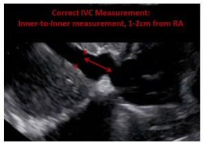 IVC correct measurement