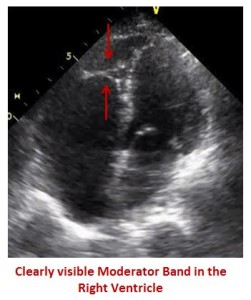 Image showing the four-chamber view. RV with the moderator band