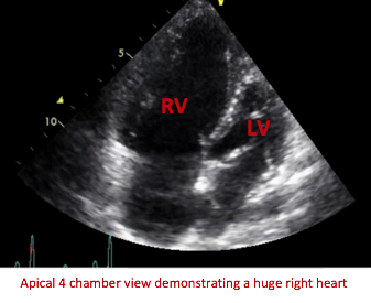 Pulmonary Hypertension Case Study Presentation