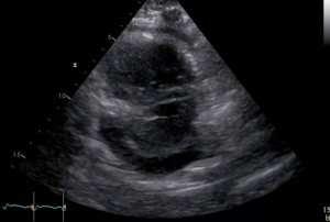 septal_D_with_peri_effusion