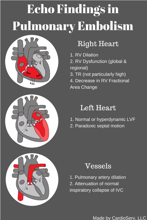 Echo in Pulmonary Embolism…the clot thickens