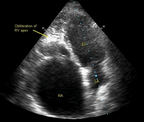 Case Study of the Week: Massive Right Atrium