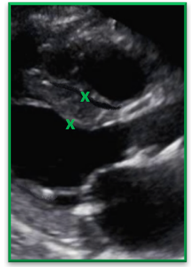 1b. Correct Trabeculation