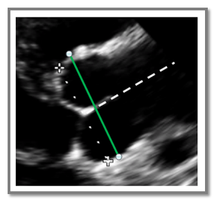 Sinus of Valsalva Correct Measurement