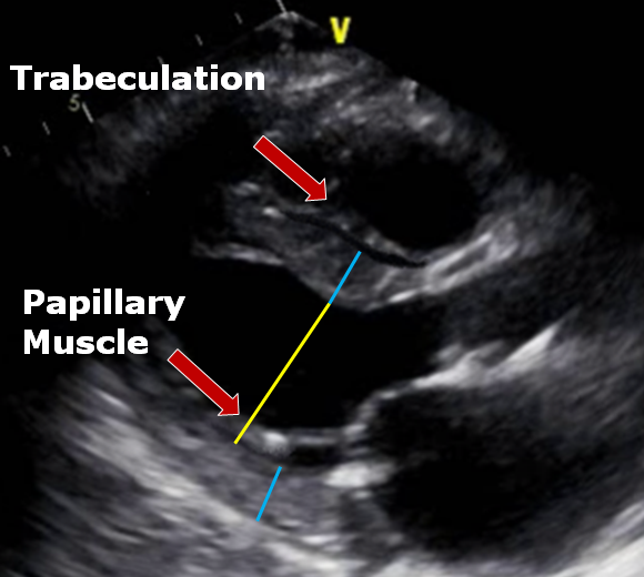 6 Pitfalls to Accurate Left Ventricular Measurements