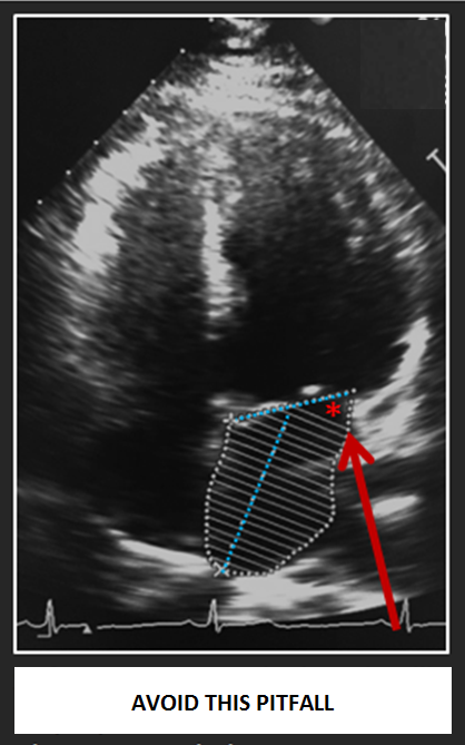 4 Steps to Mastering the Correct Way to Measure the LA Volume