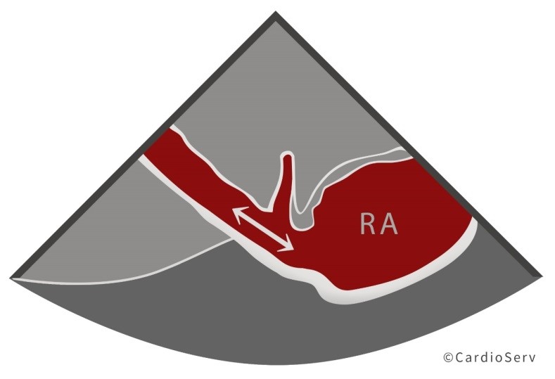 8 Things to Know About Estimation of RAP via Echocardiography