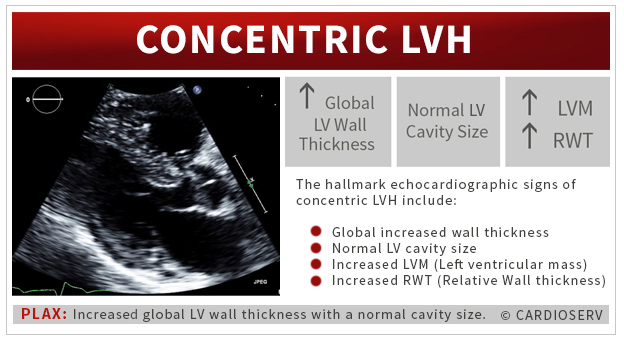 Understanding LVH Part 1: Concentric, Eccentric and Concentric Remodeling