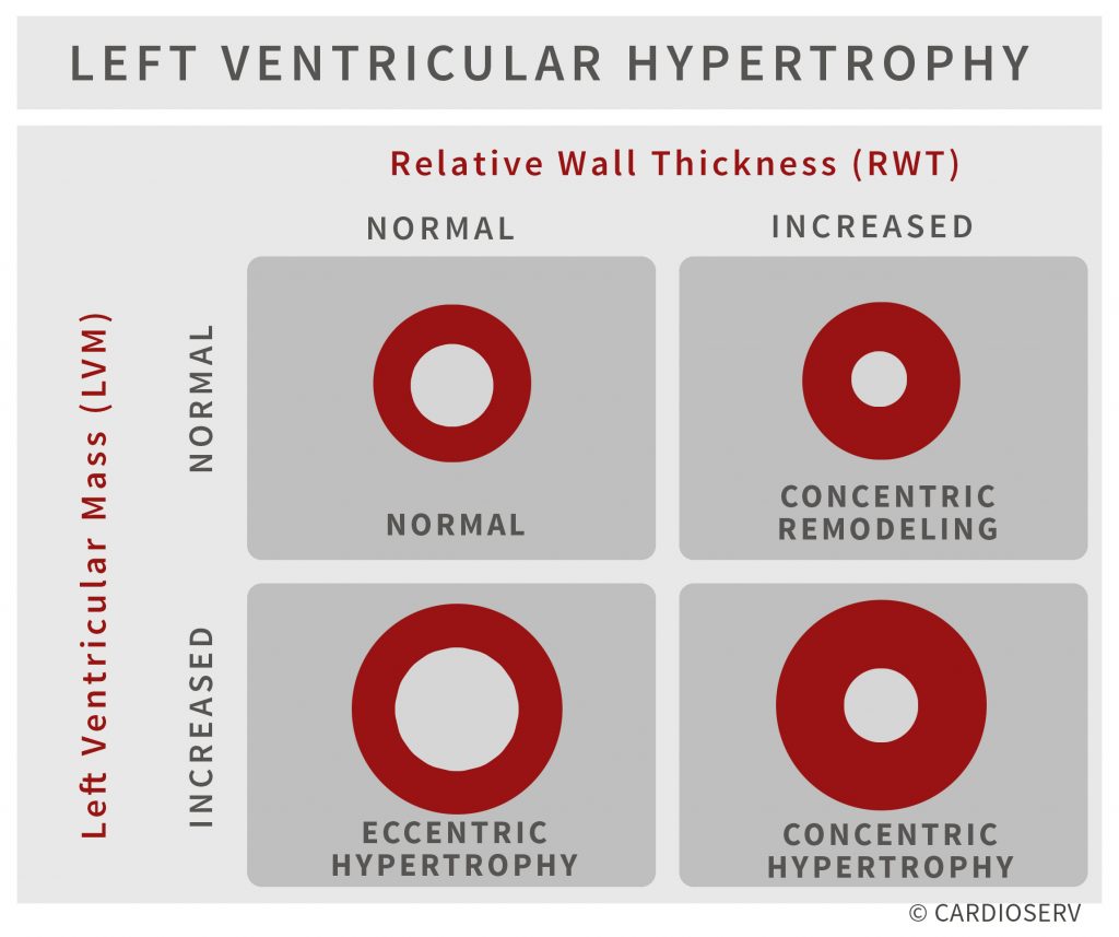 Understanding LVH Part 2: How to Measure LV Mass and Diagnose LVH