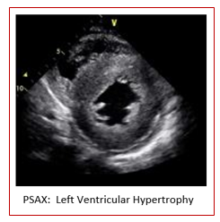 Understanding LVH Part 1:  Concentric, Eccentric and Concentric Remodeling