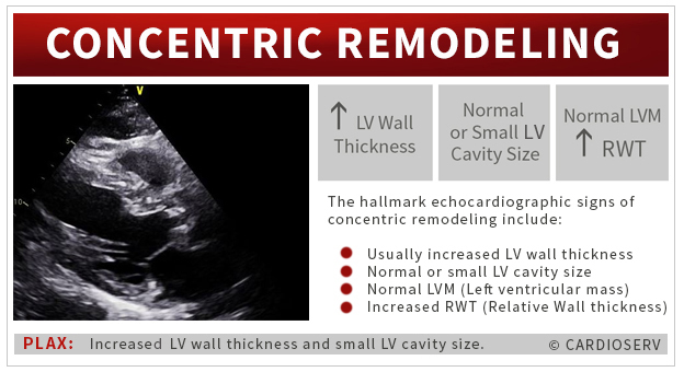 Understanding LVH Part 1: Concentric, Eccentric and Concentric Remodeling