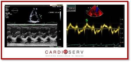 8 Tips to Correct RV Function Assessment with TAPSE & S’ Wave