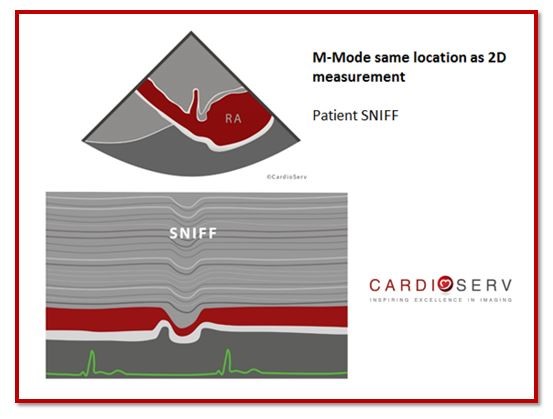 IVC Collapsibility Image