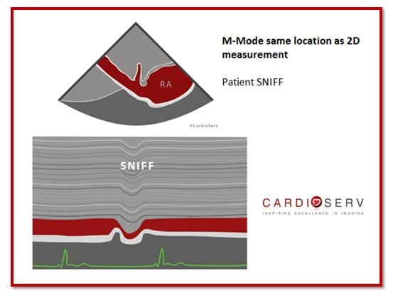 IVC Collapsibility Image