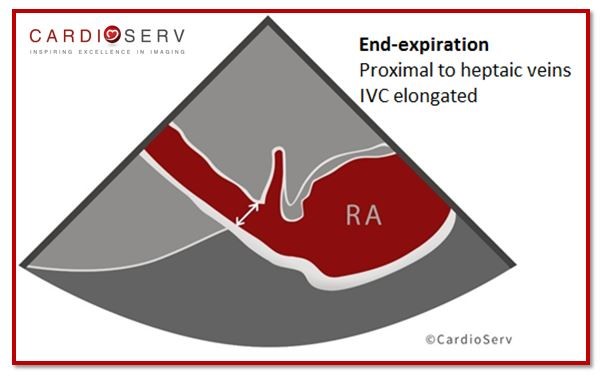 IVC Diameter Image