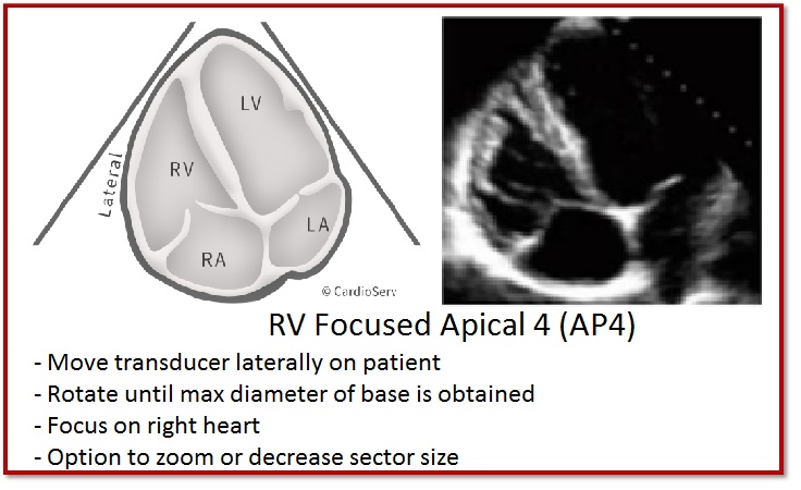 Specific Echo Parameters that Indicate Elevated LAP Cardioserv