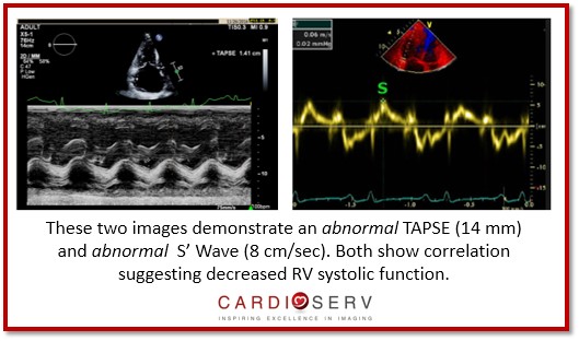 TAPSE, S' Wave Abnormal