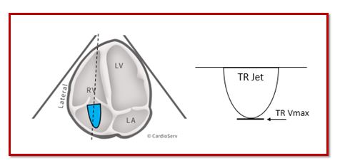 Tricuspid Regurgitation