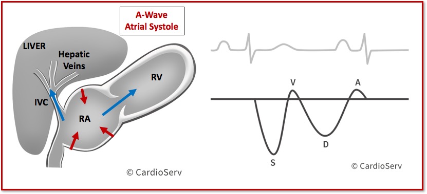 Hepatic Vein Waveform Doppler A-Wave