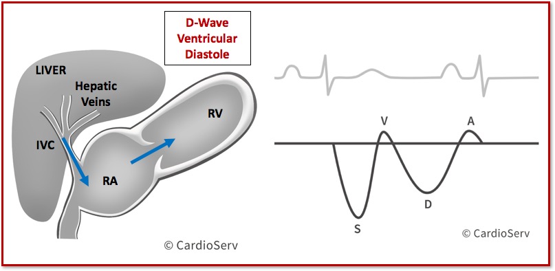 Hepatic Vein Waveform Doppler D-Wave