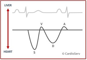 Hepatic Vein Waveform