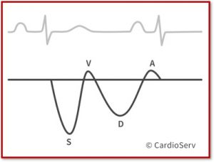 Hepatic Vein Waveform