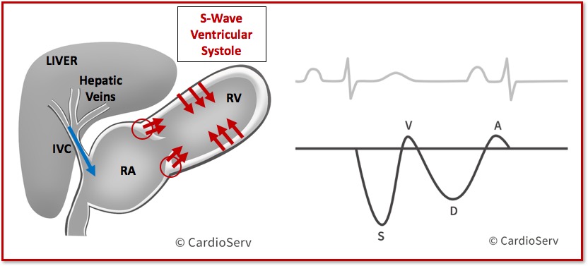 Hepatic Vein Waveform Doppler s-Wave