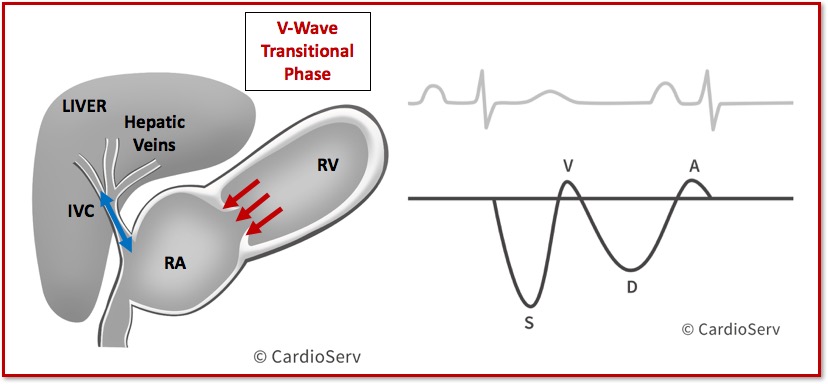 Hepatic Vein Waveform Doppler V-Wave