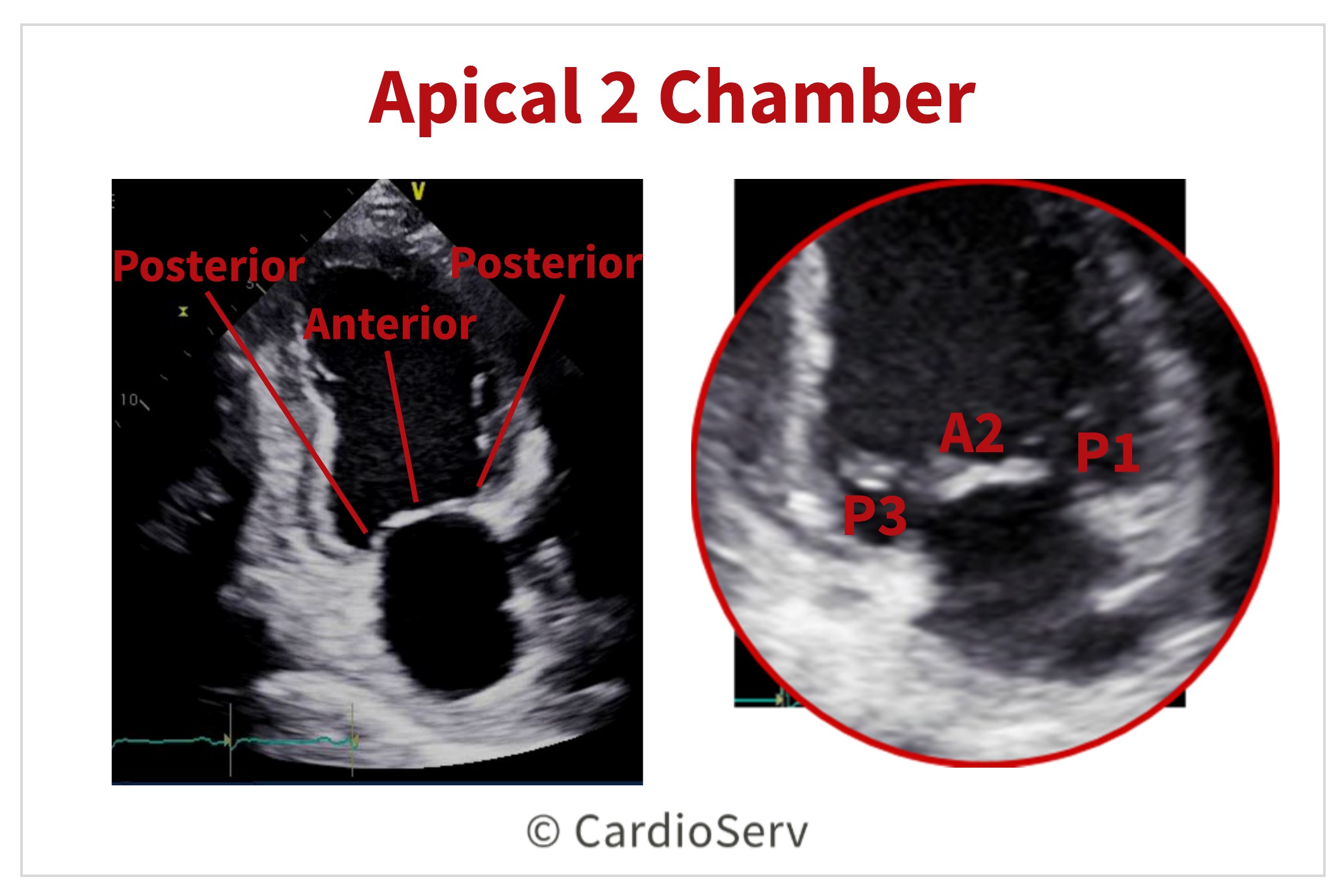 Apical 2 Chamber AP2 Mitral Valve Scallops Echo 