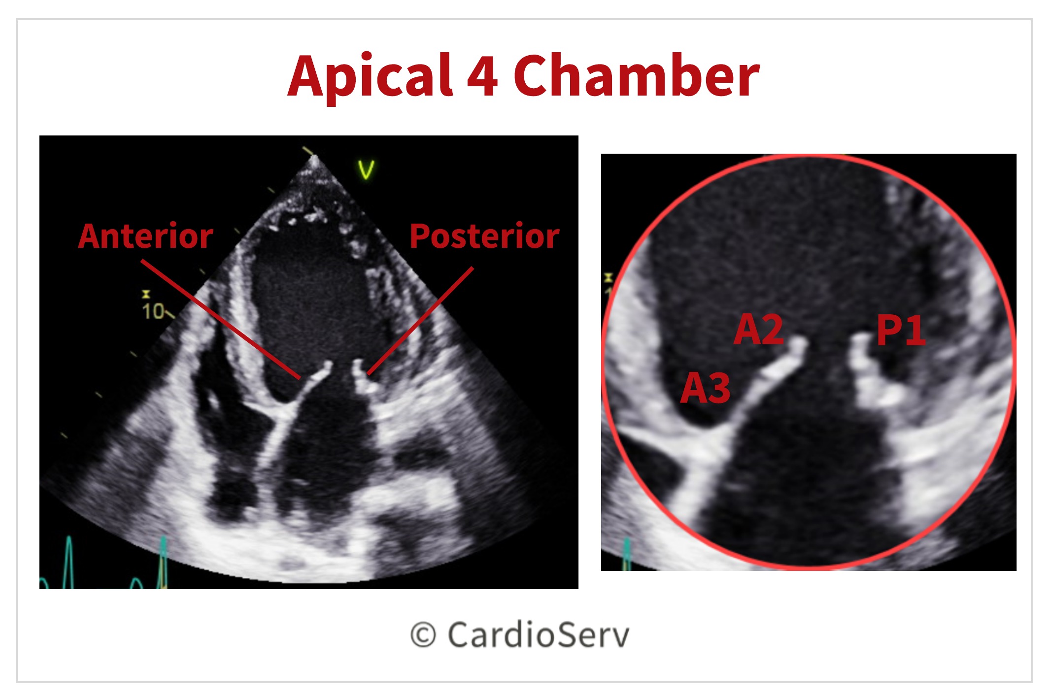 Apical 4 Chamber AP4 Mitral Valve Scallops Echo 