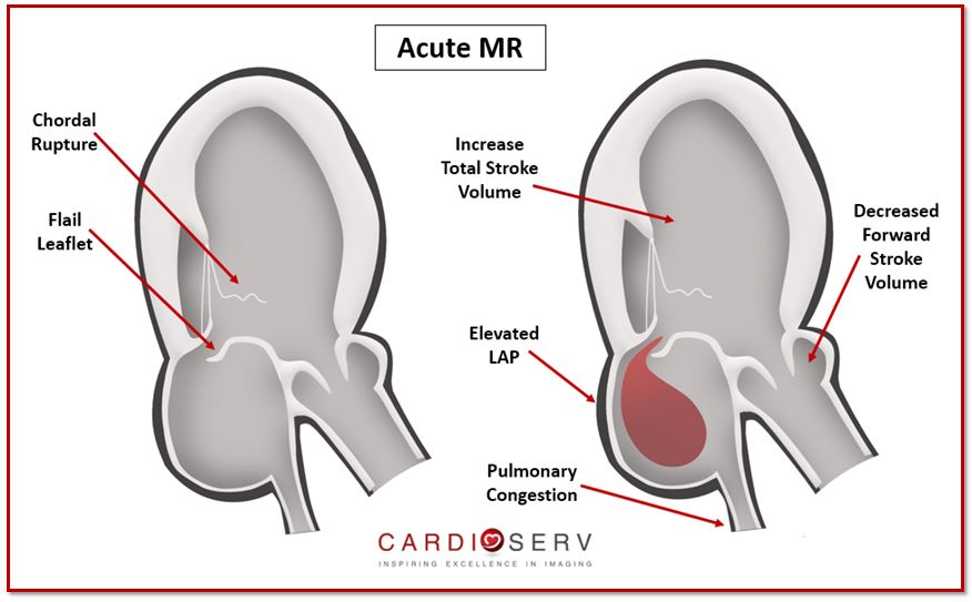 Acute MR Echo