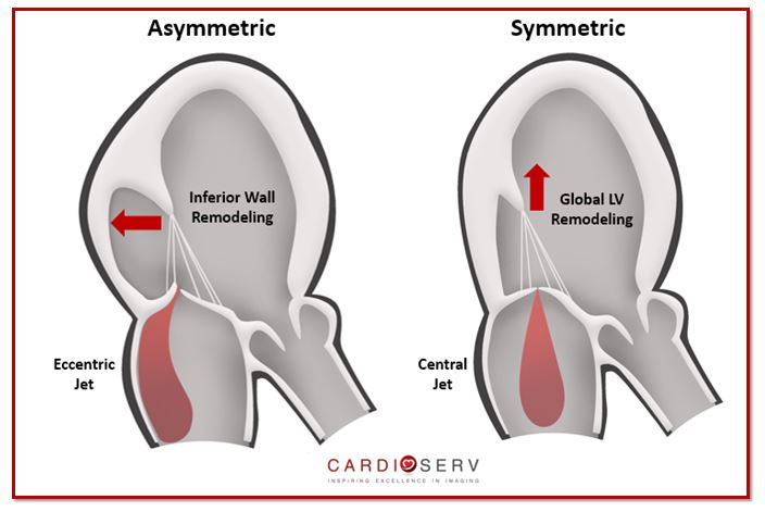 Asymmetric vs symmetric Mitral regurgitation tethering echo