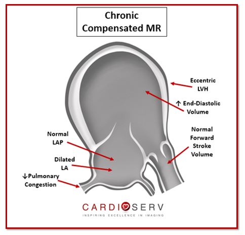 Chronic Compensated MR Echo Sonographer View