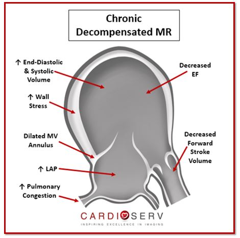 Chronic Decompensated MR Echo Sonographer View