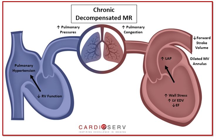 Chronic Decompensated MR Heart Lung Process