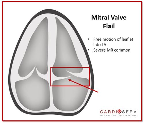 Mitral Valve Flail Anatomy Echo