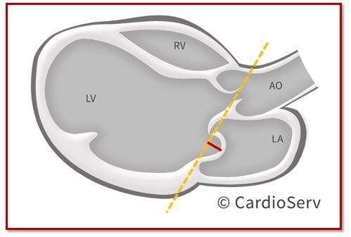 MV prolapse