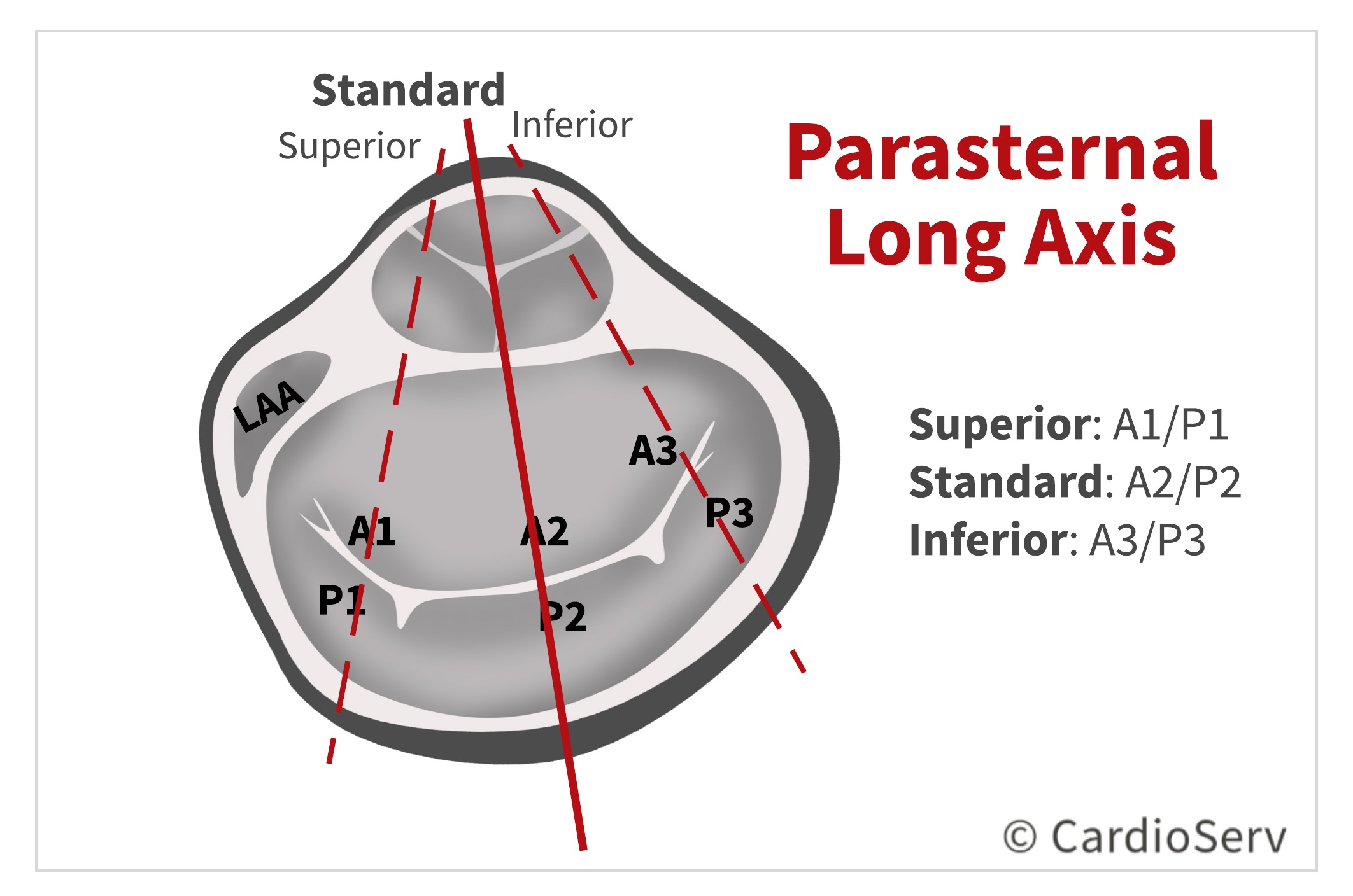 PLAX Parasternal Long Axis View Mitral Valve Scallops MV Echo