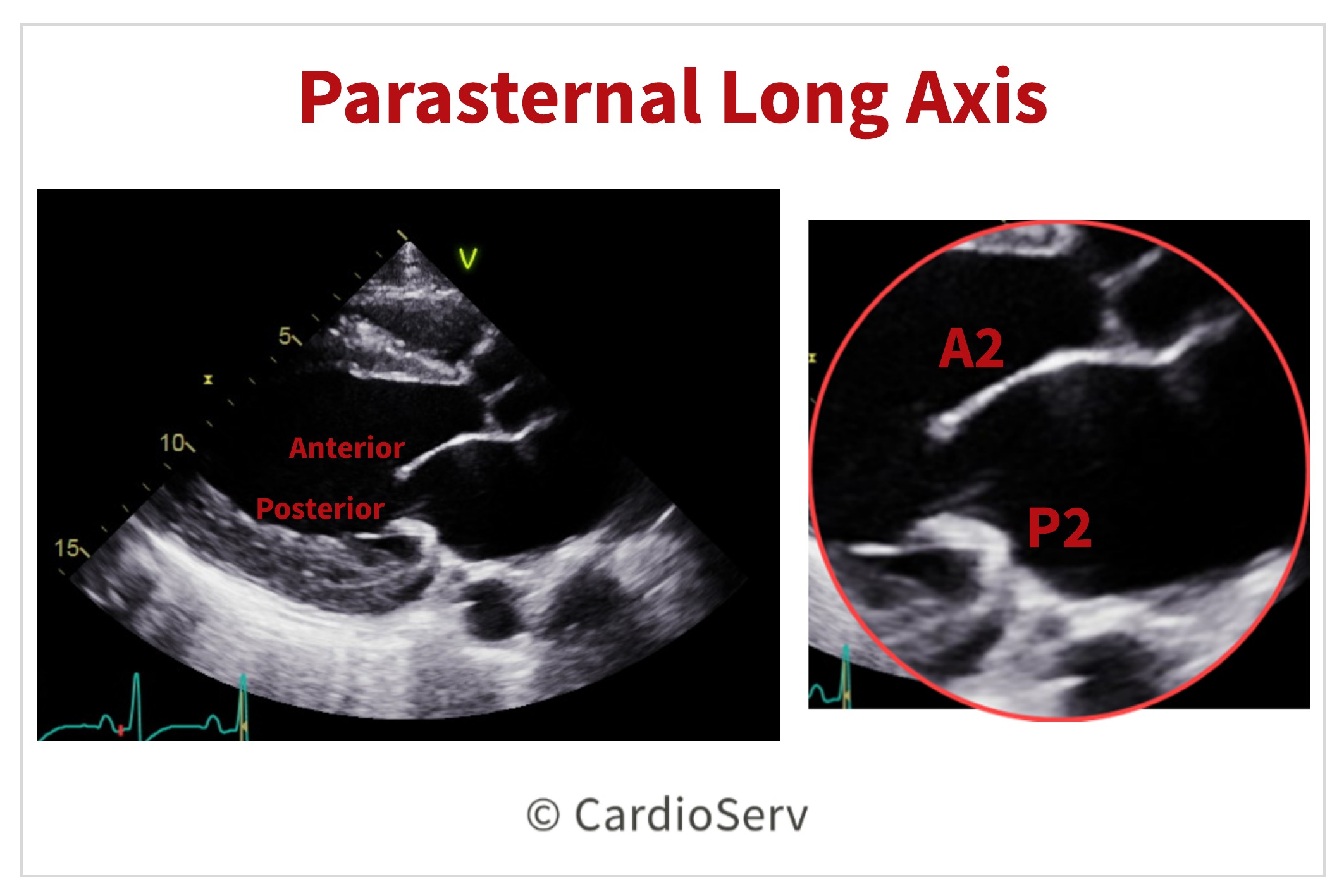 PLAX Parasternal Long Axis View Mitral Valve Scallops MV Echo