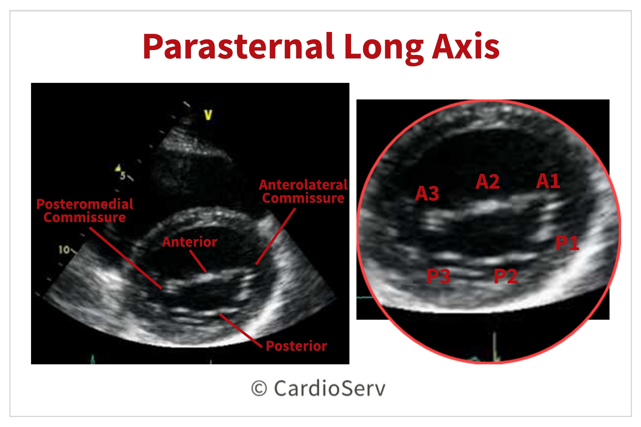 Parasternal short axis view PSAX Mitral Valve Scallops Echo 