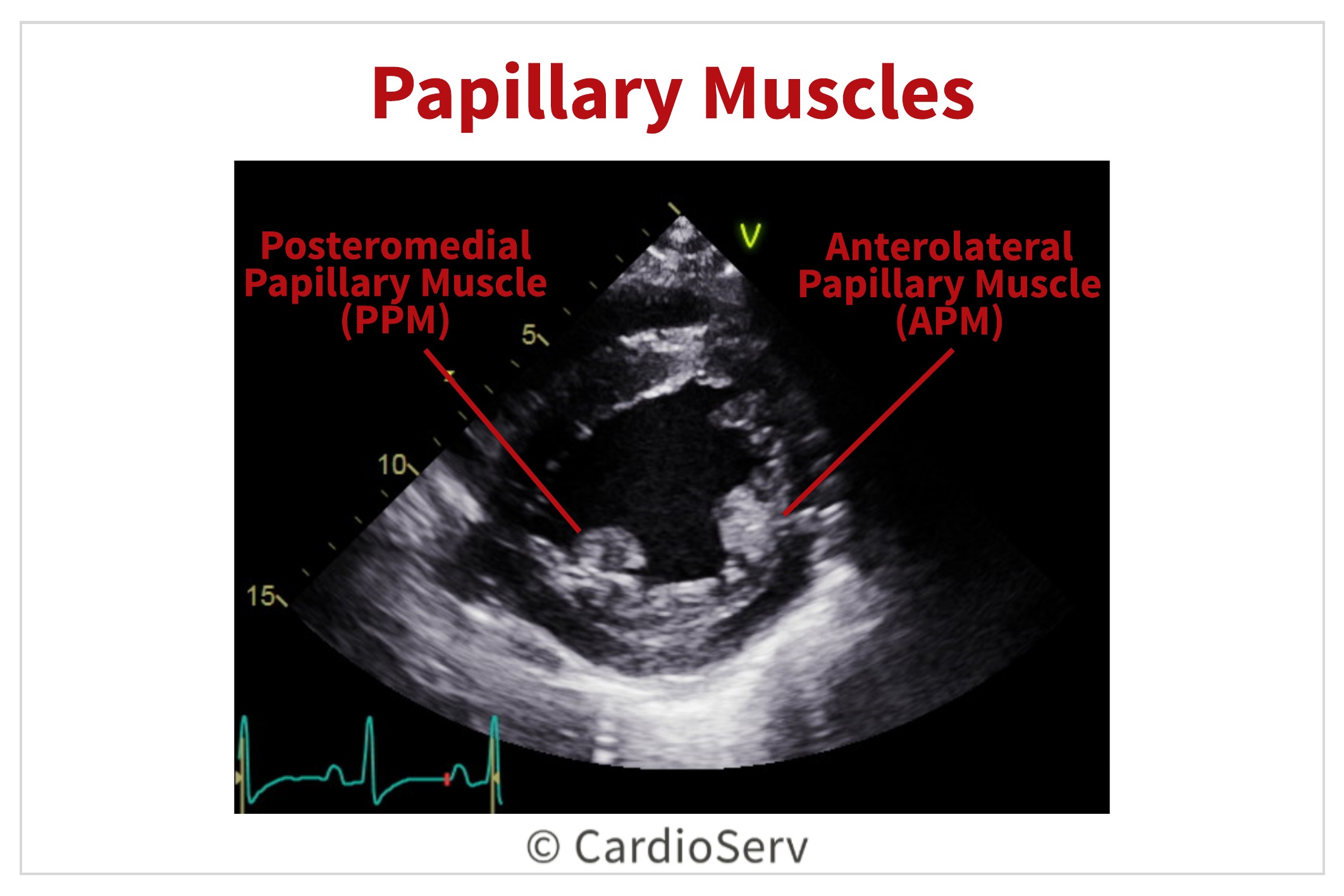 Papillary Muscles Echo Mitral Valve
