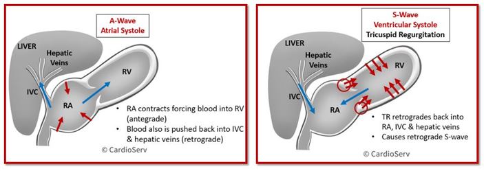 Hepatic Vein TR Cardiac Cycle