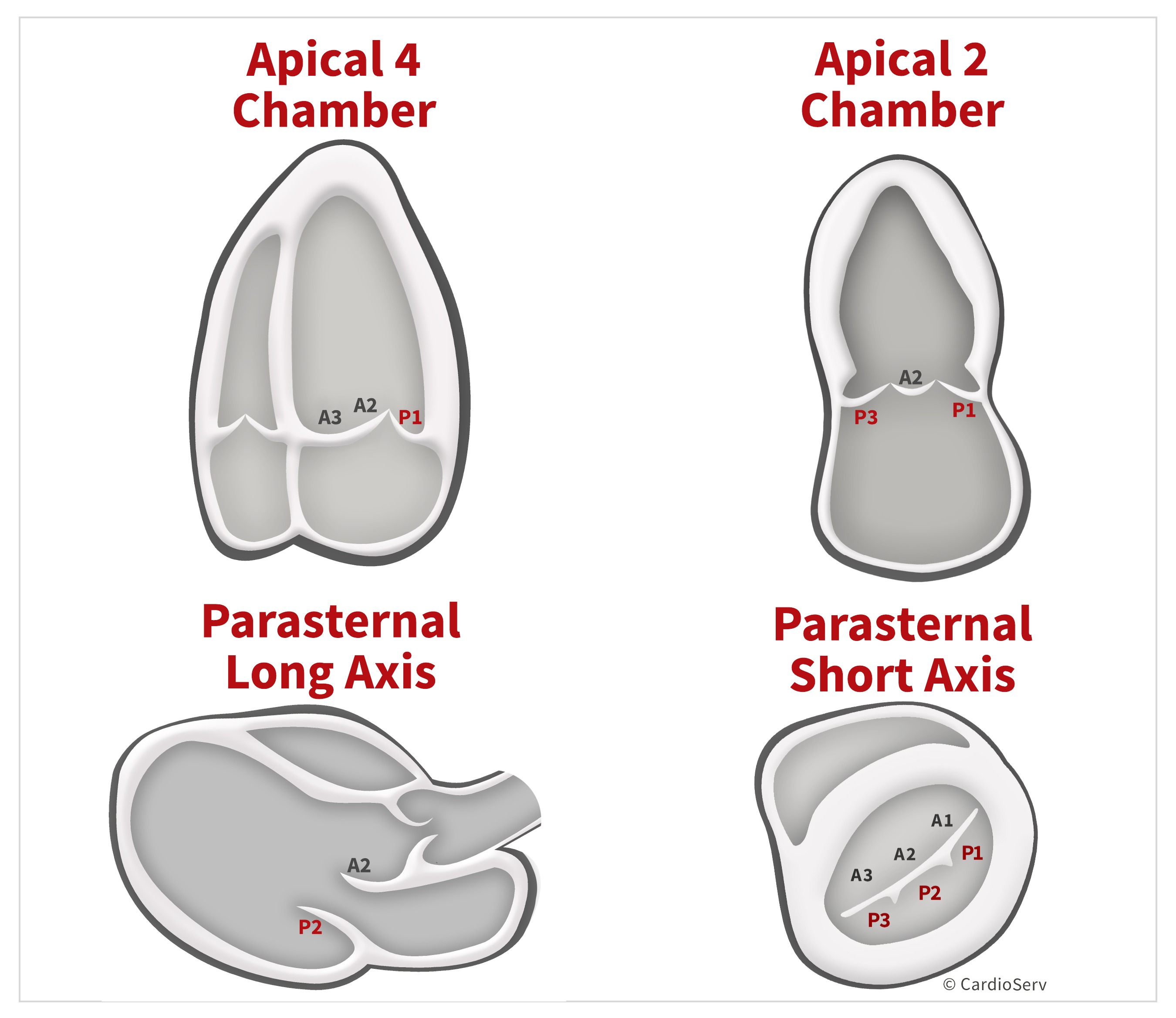 Mitral Scallops Summary Table Transthoracic Echo TTE