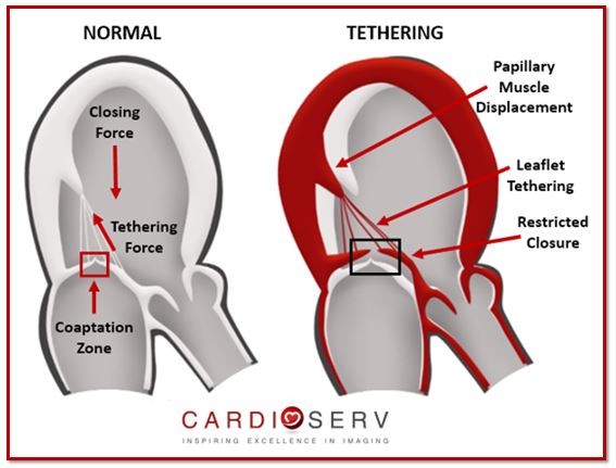 Mitral Valve Leaflet Tethering Echo