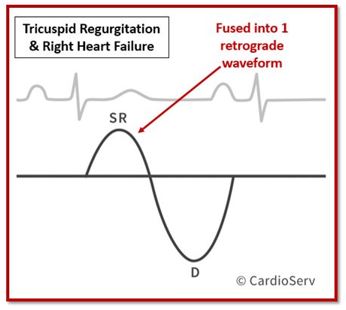 TR & Right Hear Failure Hepatic Vein Fused Biphasic