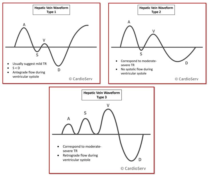 TR Hepatic Vein Type