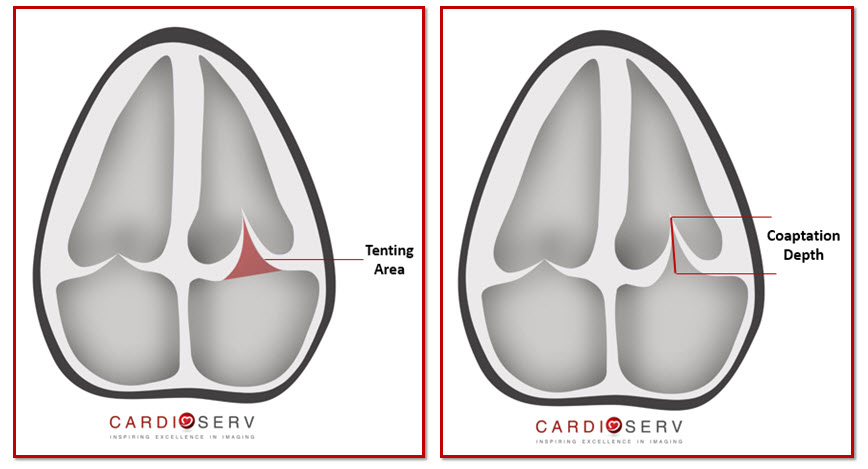 Mitral Valve Tenting Area and Coaptation Depth Secondary Mitral Regurgitation