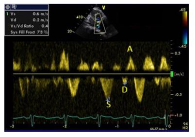 Hepatic Vein Waveform